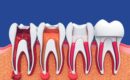 single sitting root canal treatment