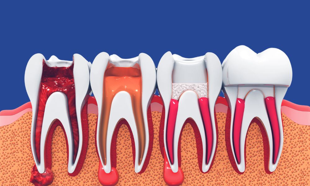 single sitting root canal treatment